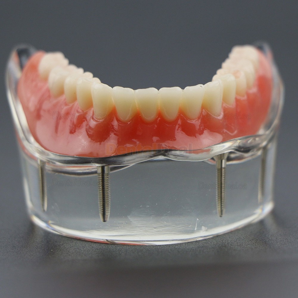 Dental Teeth Implant Overdenture Model Demo Study 6002 02 Lower Jaw 4 Implants
